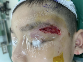 8岁孩子磕破眉弓处顺德和平美容缝合让疤痕“无迹可寻”
