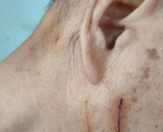 极目帮办|小猫从天而降将七旬爹爹抓伤，面部留下10厘米伤口