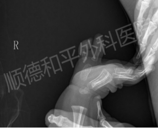 2岁宝宝成功矫正多指畸形：揭秘手指畸形的黄金手术时机与专业评估