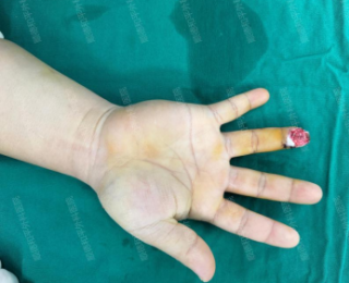 手指头意外损毁后可以立马做“手指再造”吗？顺德和平外科医院