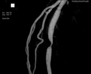 拔掉“腿上的钉子户”！这项新技术让糖尿病足患者有希望了！