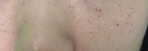 “色斑”难题如何解？奉劝所有准备冬天祛斑的姐妹一定要知道这些，杏林中胚疗法