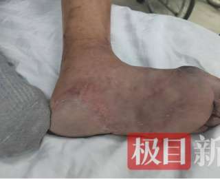 腿保住了！襄阳市中心医院微创取栓，让高龄“腿梗”患者免于截肢