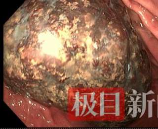 巧用内镜“化整为零”！十堰人医成功摘除罕见巨大胃石