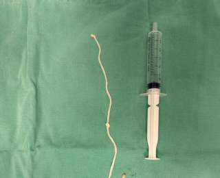 75岁婆婆乳房瘙痒手术竟取出30厘米活虫！医生：千万别吃生肉